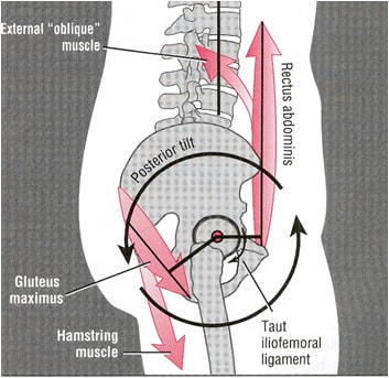 posterior pelvic tilt 1